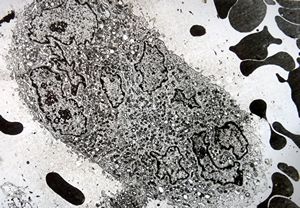 F,25y. | giant multinuclear osteoclast - aneurysmatic cyst - tibia F,25y. | giant multinuclear osteoclast - aneurysmatic cyst - tibia
